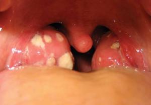 placche tonsillari