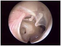Perforazione della membrana timpanica